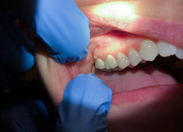 Urgent Tooth Repair in WA